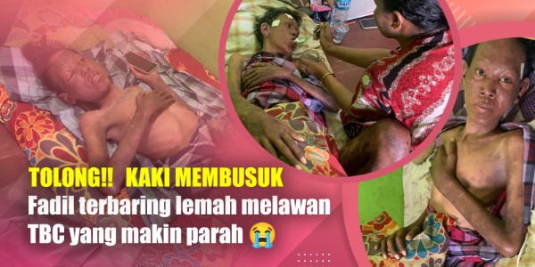 URGENT ! Kulit dan Tubuh Fadil Tergerogoti TBC, Kusta, dan Infeksi Paru-Paru