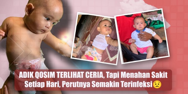 Tanpa Anus Sejak Lahir, Qosim Terancam Infeksi Usus Karena Operasi Ditunda