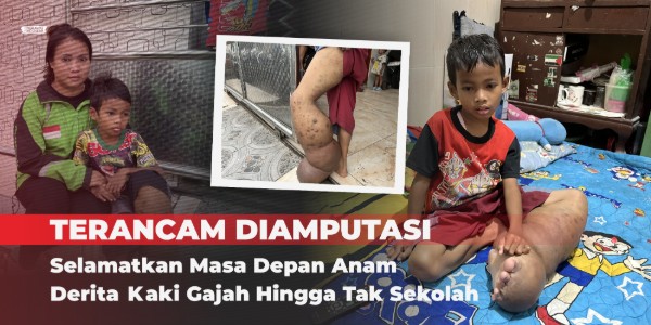 Ibu Ojol Berjuang, Tak Biarkan Anak Diamputasi!